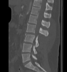 Thoracolumbar Chance Fracture CT Sagittal